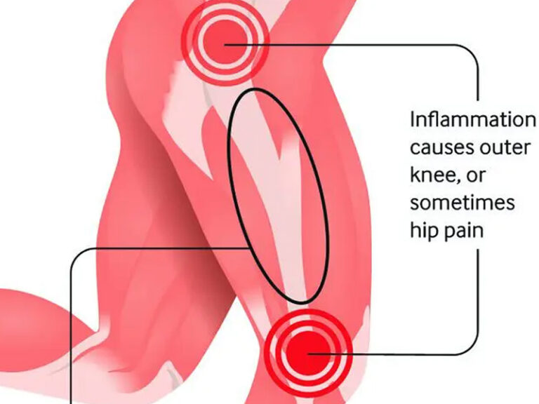 Iliotibial Band Syndrome | Aiello Family Chiropractic | Brentwood, TN